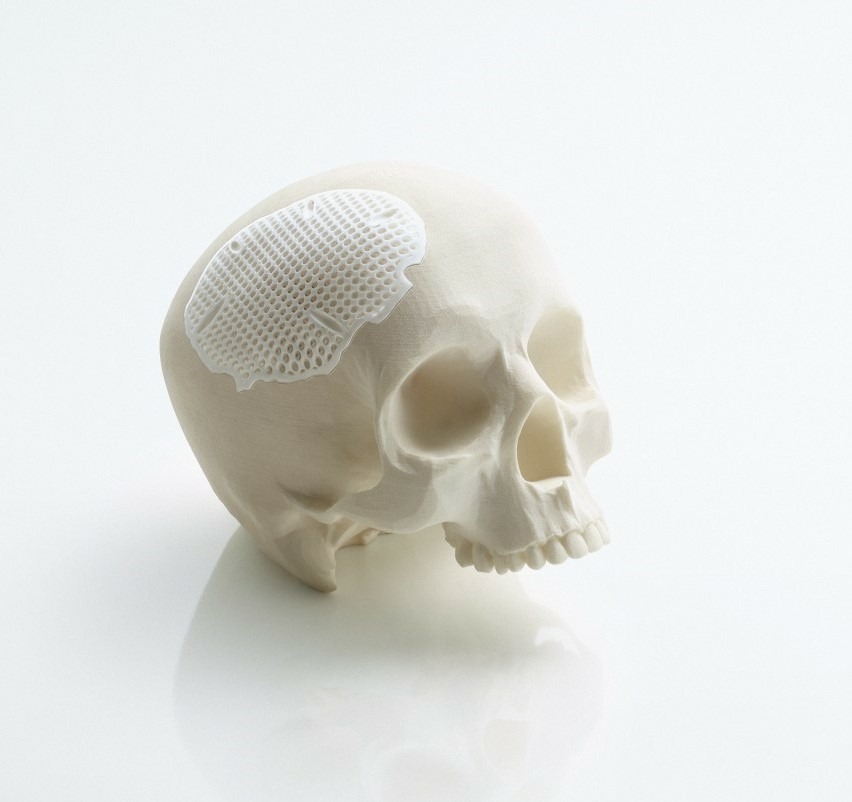 Did you know that patient-specific cranial implants are producible using ceramic additive manufacturing?