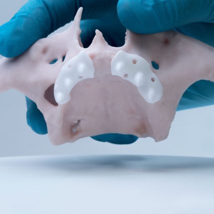 two-zirconia-subperiostal-implants-on-atrophic-maxilla-modell